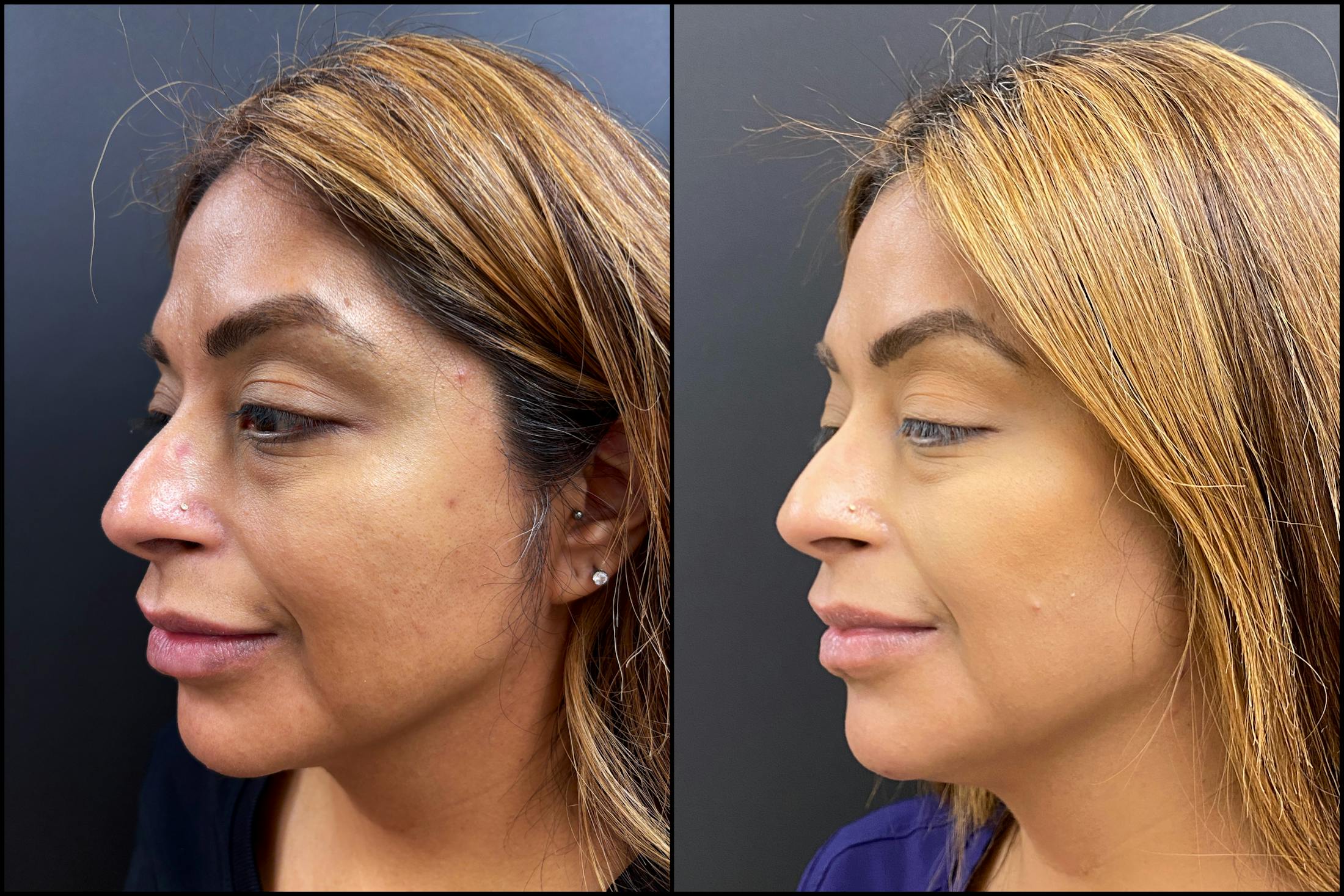 Hyaluronic Acid Injections Before & After Gallery - Patient 164128 - Image 2