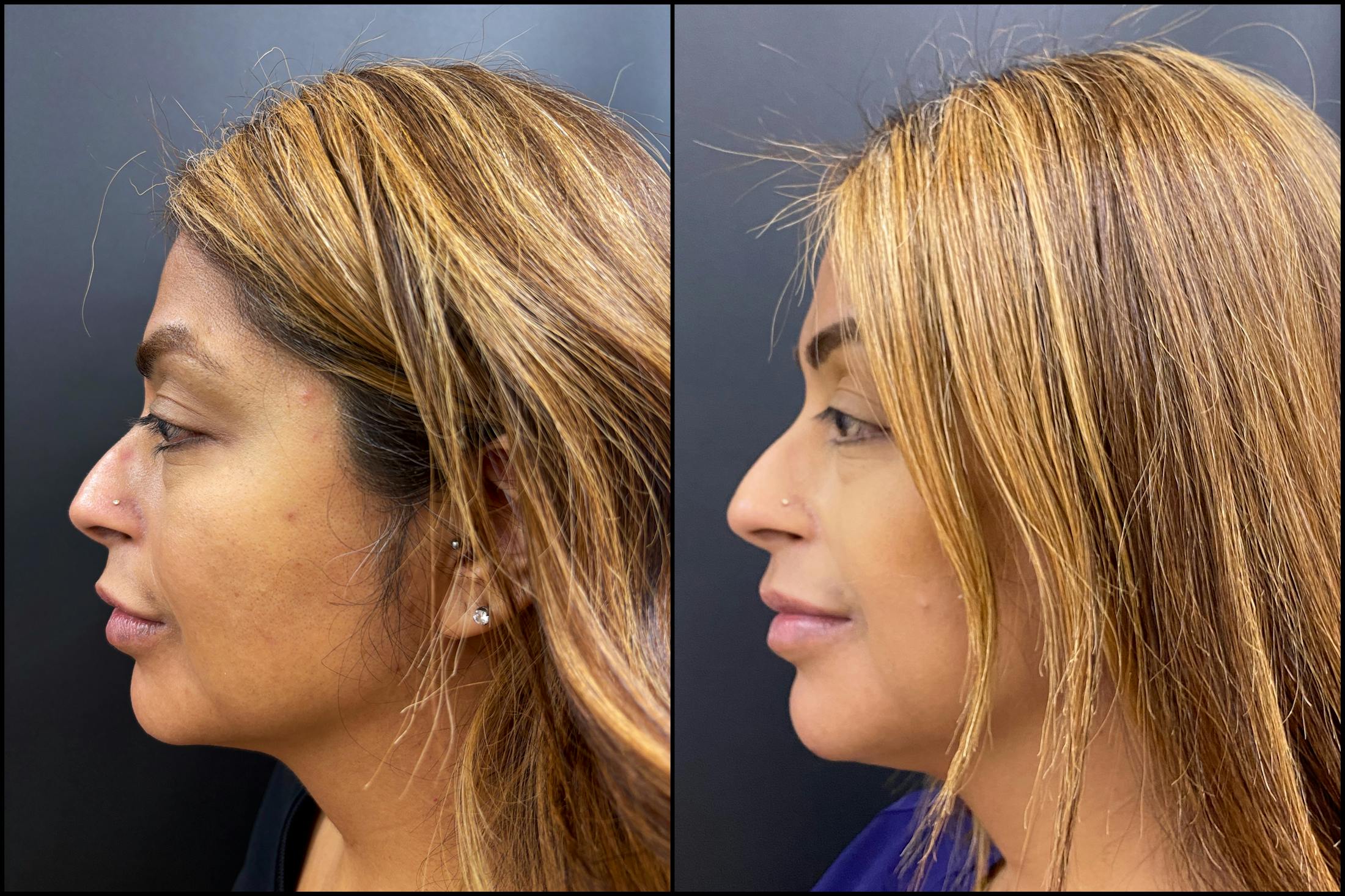 Hyaluronic Acid Injections Before & After Gallery - Patient 164128 - Image 3