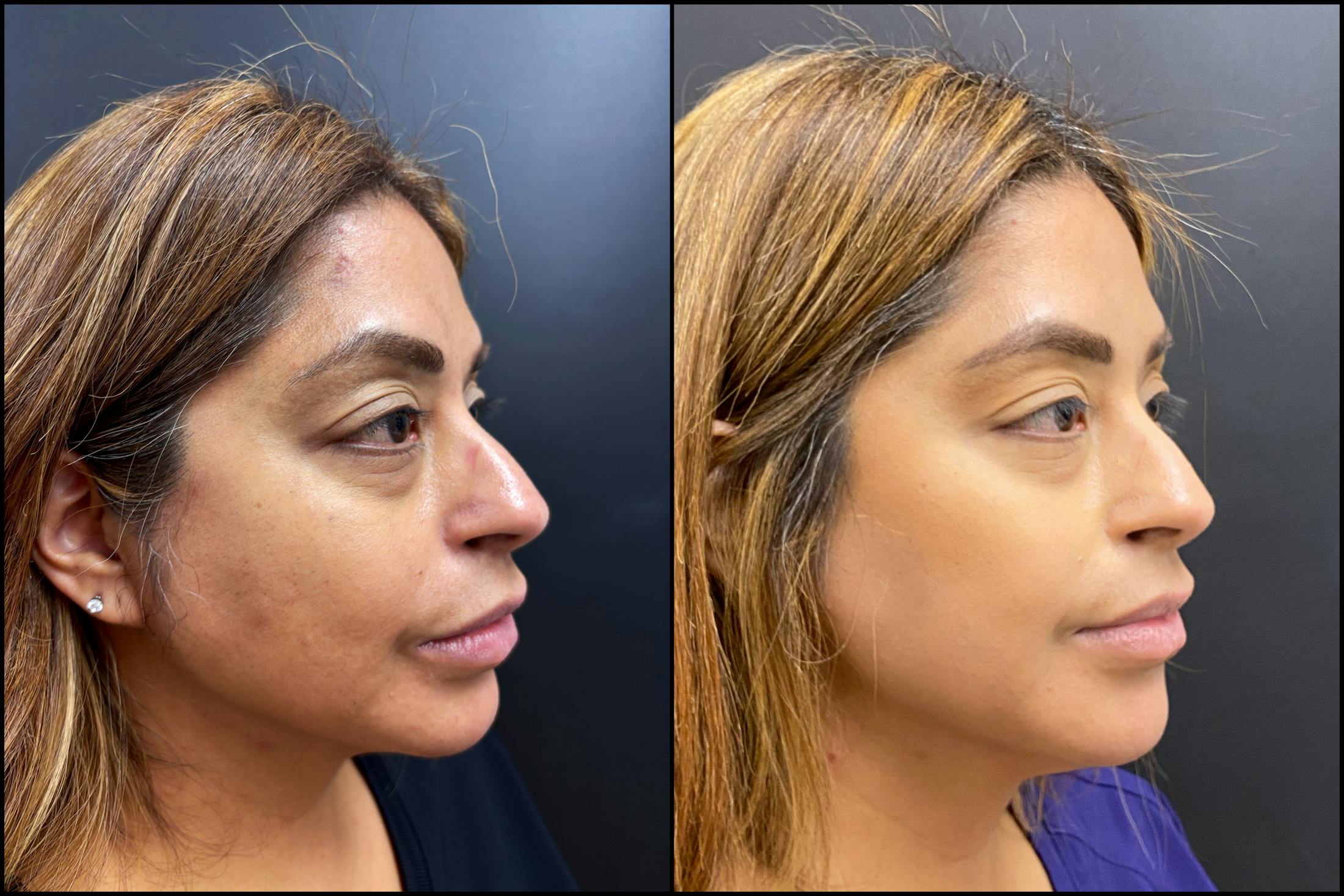 Hyaluronic Acid Injections Before & After Gallery - Patient 164128 - Image 1