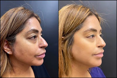 Hyaluronic Acid Injections Before & After Gallery - Patient 164128 - Image 1