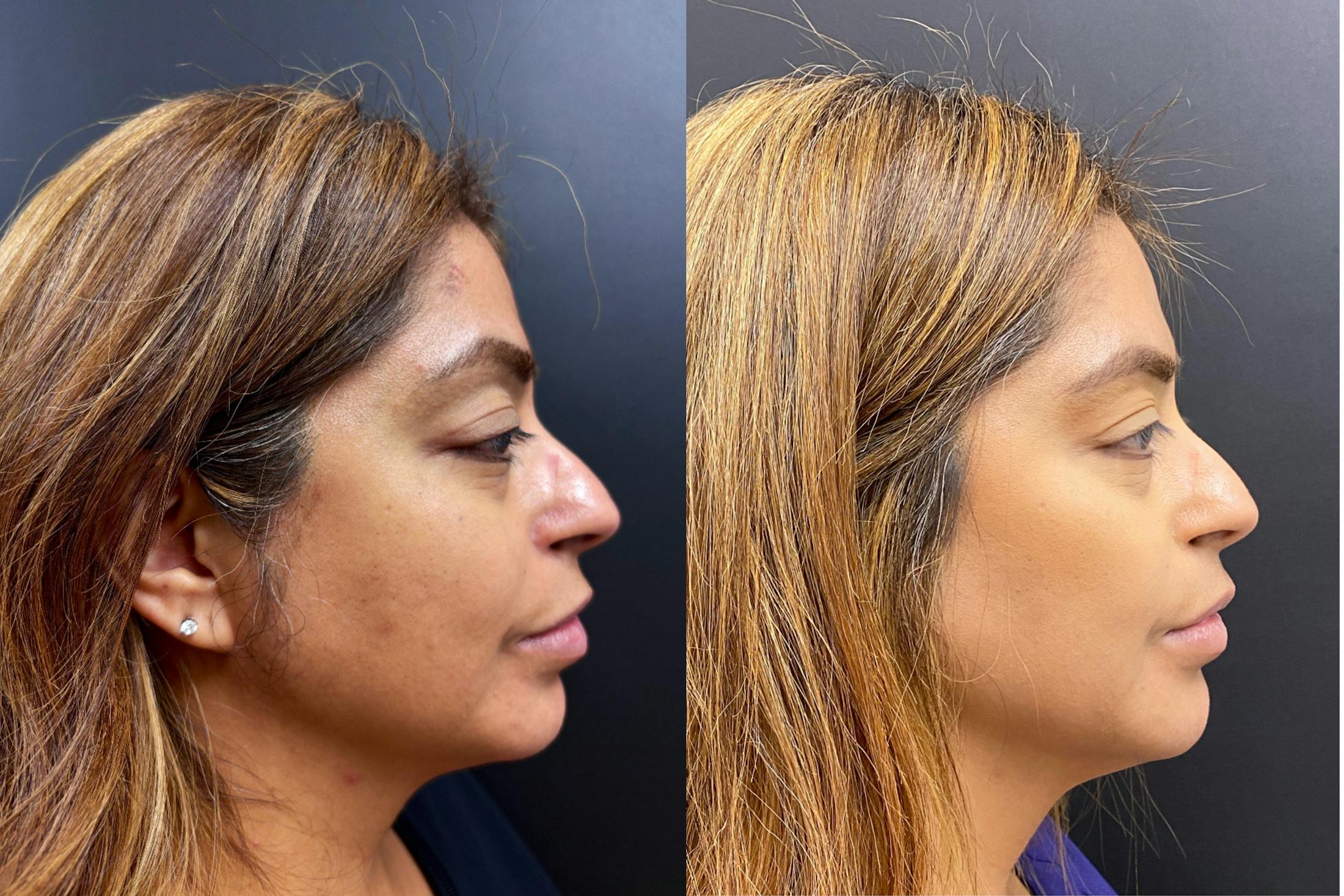 Hyaluronic Acid Injections Before & After Gallery - Patient 164128 - Image 4