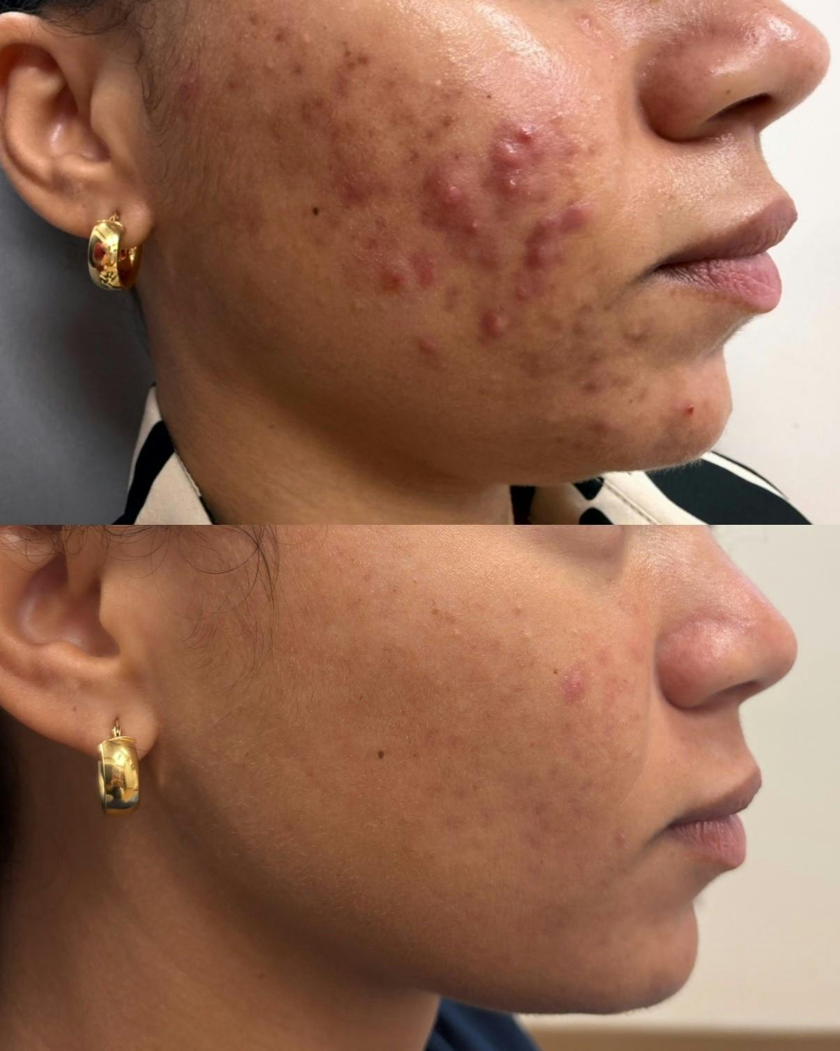 ZO® Skin Health and IS Clinical Before & After Gallery - Patient 312678 - Image 1