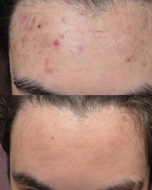 ZO® Skin Health and IS Clinical Before & After Gallery - Patient 323339 - Image 1