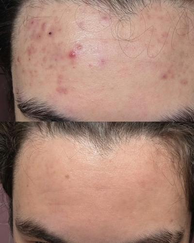 ZO® Skin Health and IS Clinical Before & After Gallery - Patient 323339 - Image 1
