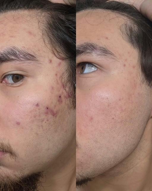 ZO® Skin Health and IS Clinical Before & After Gallery - Patient 247730 - Image 1