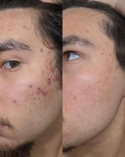ZO® Skin Health and IS Clinical Before & After Gallery - Patient 247730 - Image 1