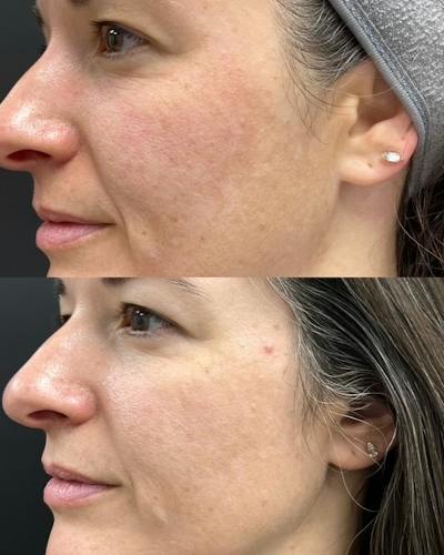 ZO® Skin Health and IS Clinical Before & After Gallery - Patient 823476 - Image 1