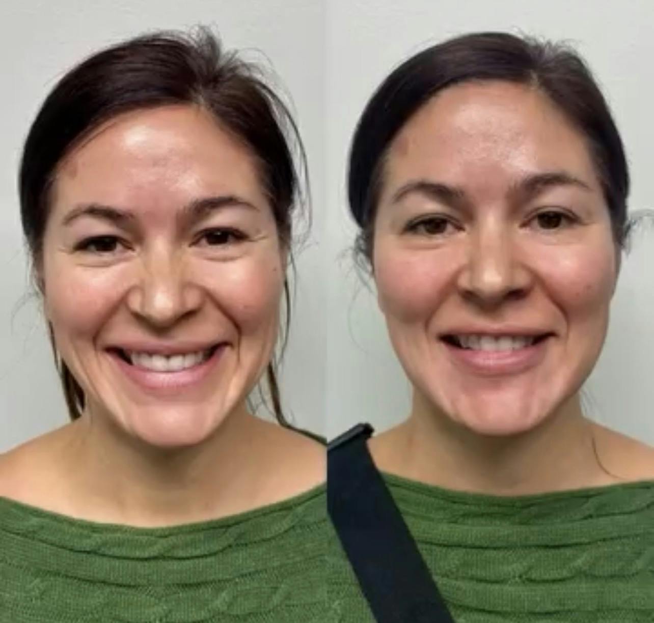Hyaluronic Acid Injections Before & After Gallery - Patient 130105 - Image 2