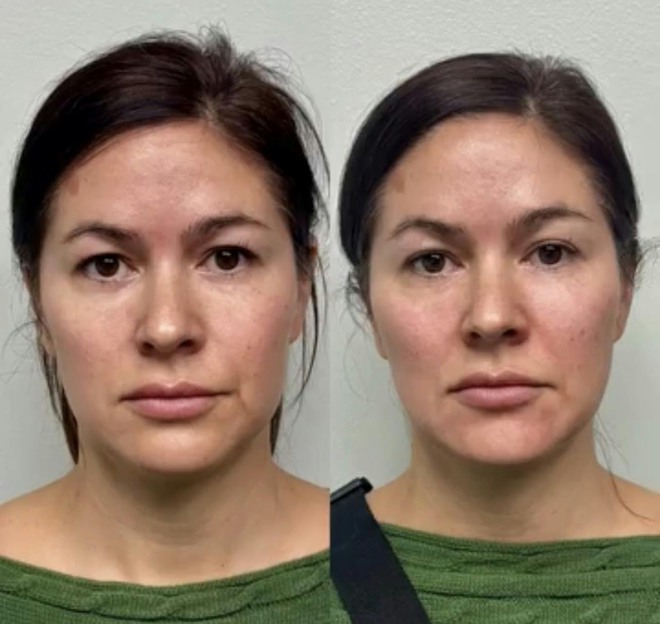 Hyaluronic Acid Injections Before & After Gallery - Patient 130105 - Image 1
