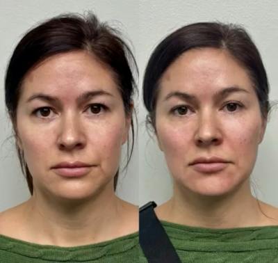Hyaluronic Acid Injections Before & After Gallery - Patient 130105 - Image 1