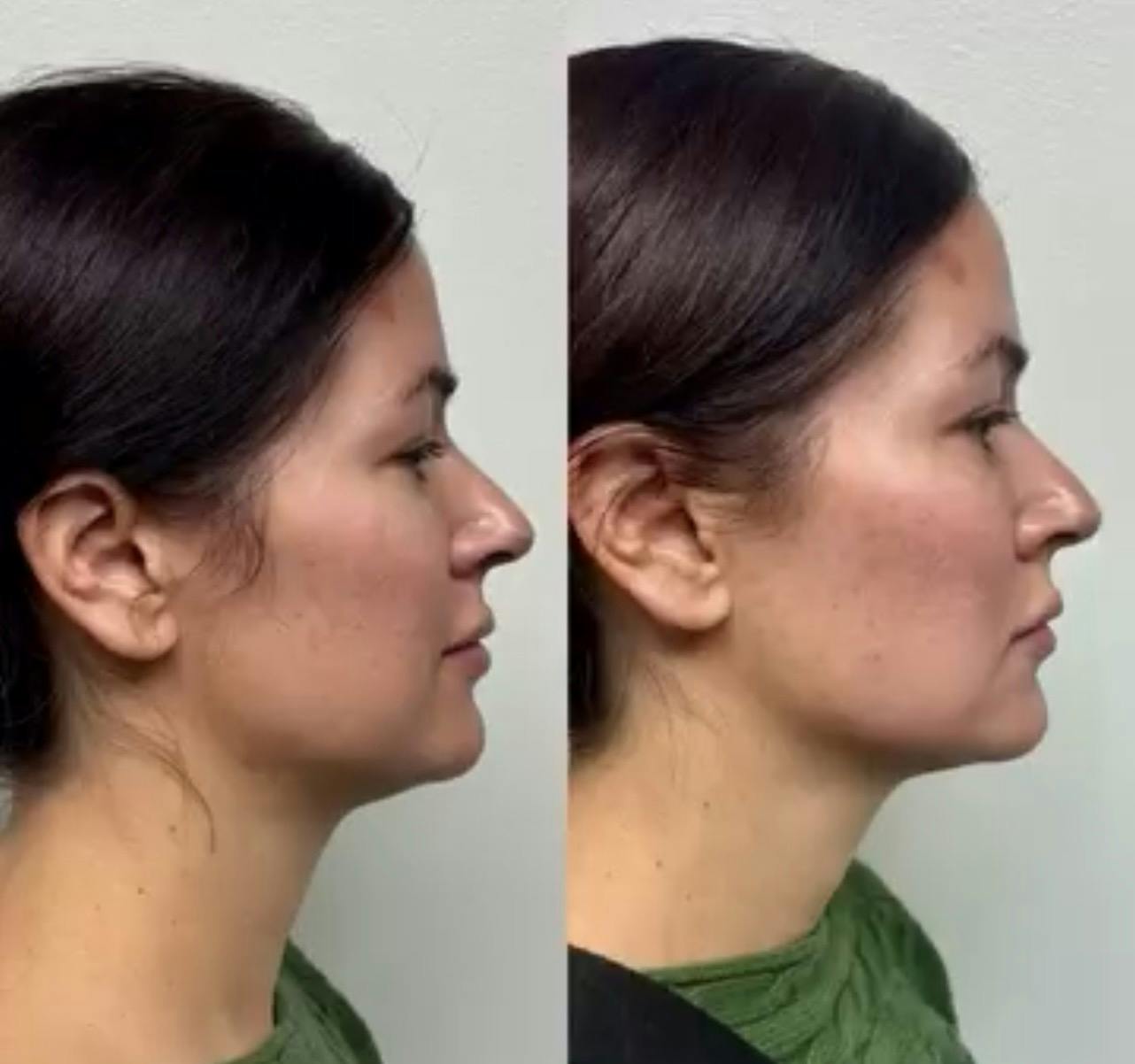 Hyaluronic Acid Injections Before & After Gallery - Patient 130105 - Image 3