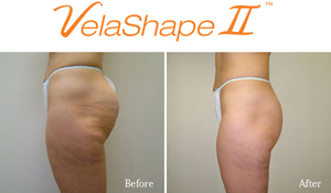 Dream Spa Medical Blog | That Cellulite has got-to-GO, say hello to VelaShape!