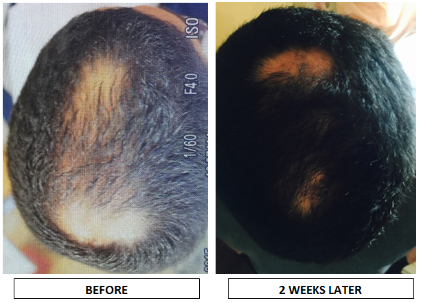 Non-surgical Hair Restoration: A New Results-Based Innovation - Boston, MA