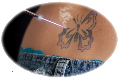 Laser Tattoo Removal with the PicoSure