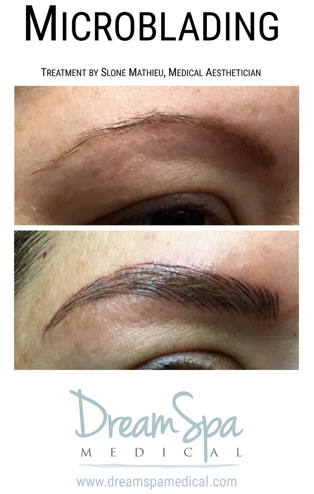 Dream Spa Medical Blog | Before and After Microblading Treatment by Slone Mathieu, Medical Aesthetician - Brookline MA