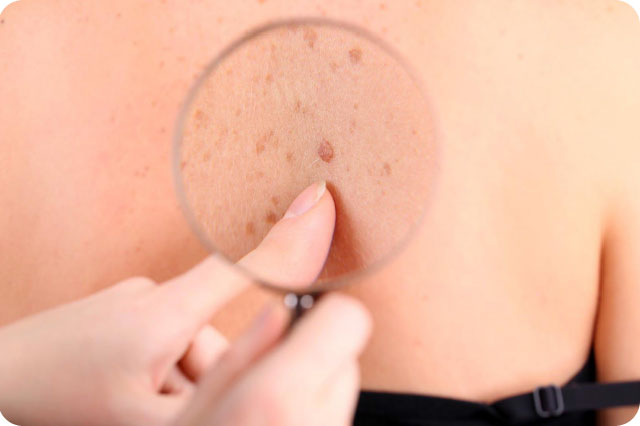 Dream Spa Medical Blog | What are Skin tags? Brookline, MA