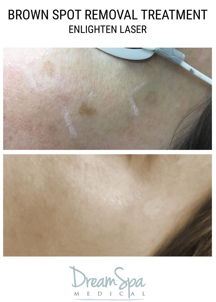 Dream Spa Medical Blog | Brown Spot Removal Treatment