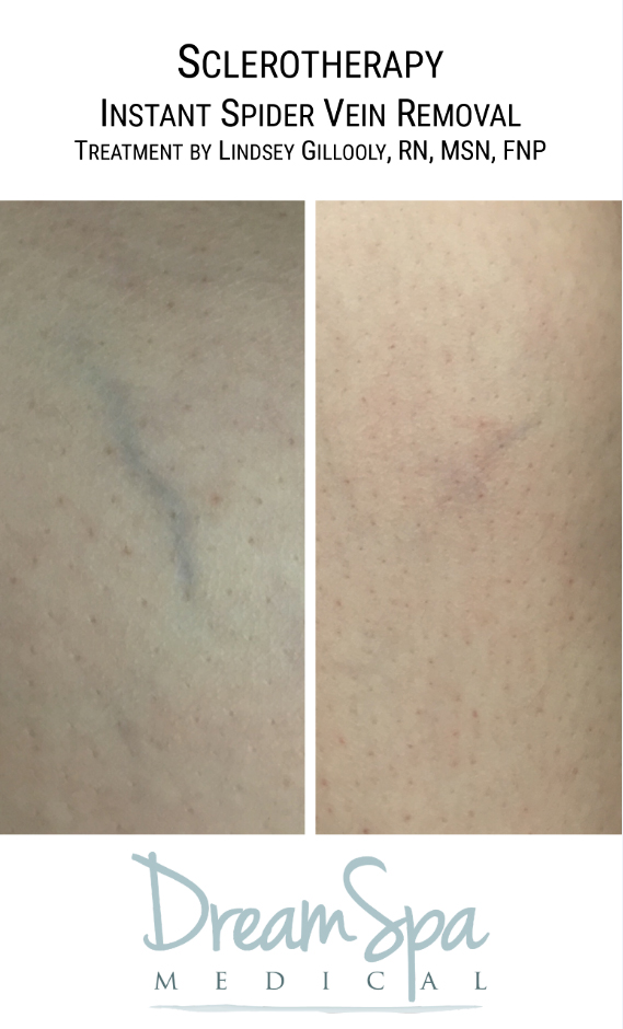 Dream Spa Medical Blog | Sclerotherapy Instant Spider Vein Removal Treatment - Brookline, MA
