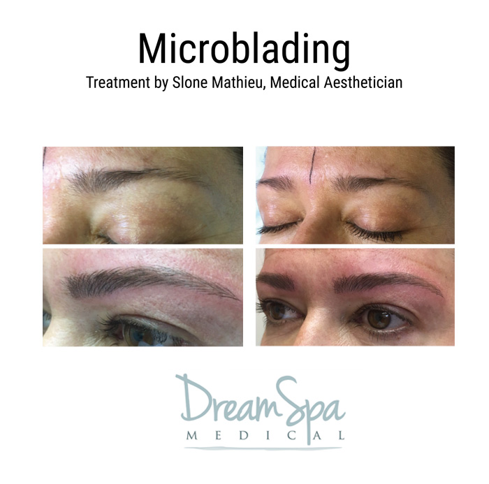Dream Spa Medical Blog | Microblading Treatment by Slone Mathieu