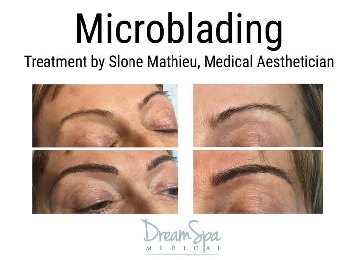 Dream Spa Medical Blog | Microblading Treatment by Slone Mathieu - Brookline, MA