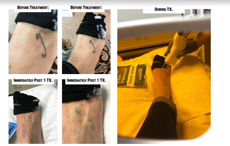 Dream Spa Medical Blog | Tattoo Removal Treatment