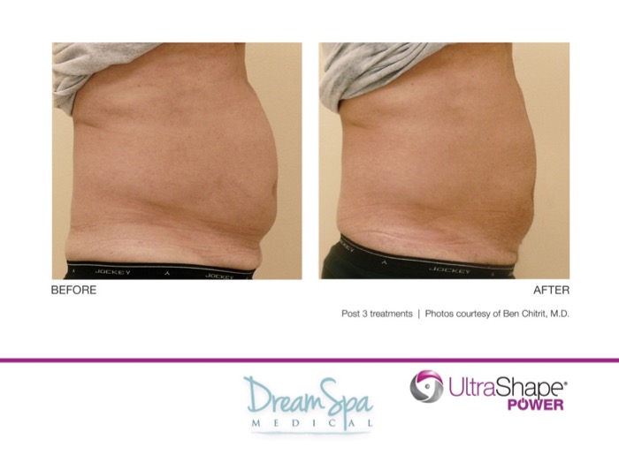Dream Spa Medical Blog | UltraShape POWER Before & After Treatments