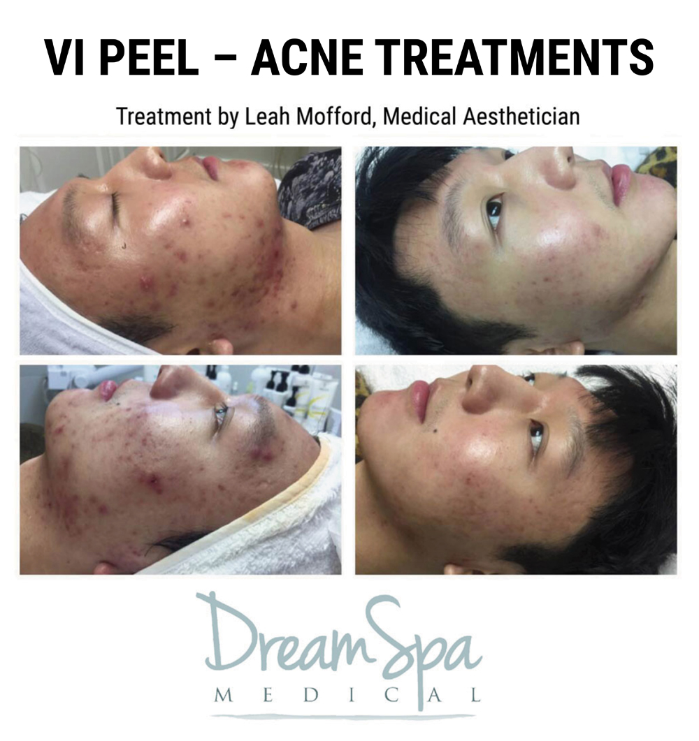 Dream Spa Medical Blog | Vi Peel Acne Treatments - Brookline MA