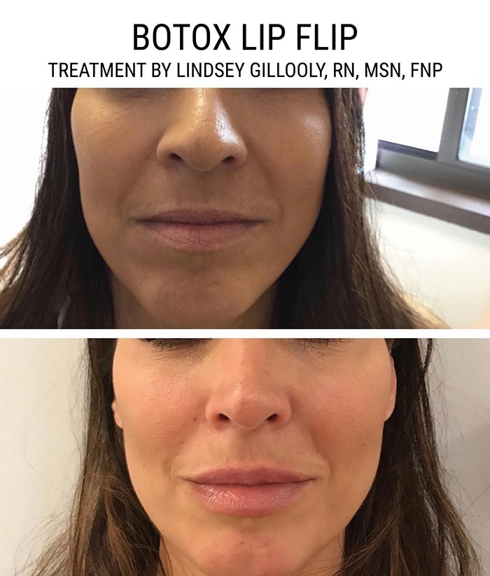 Dream Spa Medical Blog | Botox Lip Flip