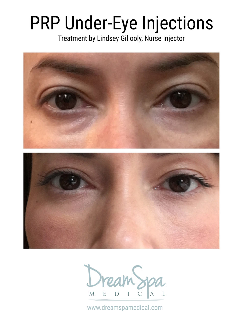 Dream Spa Medical Blog | Eye Rejuvenation Treatment Restores A Youthful Look