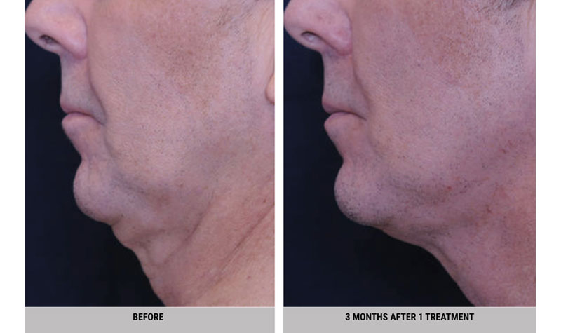 Dream Spa Medical Blog | Double Chin or Saggy Neck Resolution