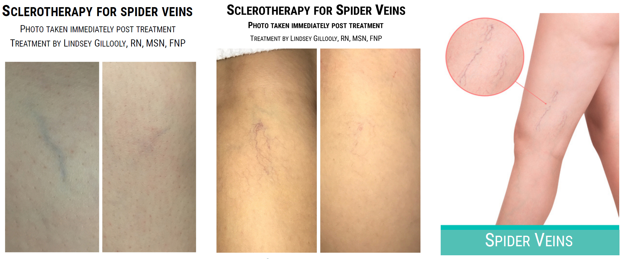 Dream Spa Medical Blog | Sclerotherapy To Treat Spider Veins