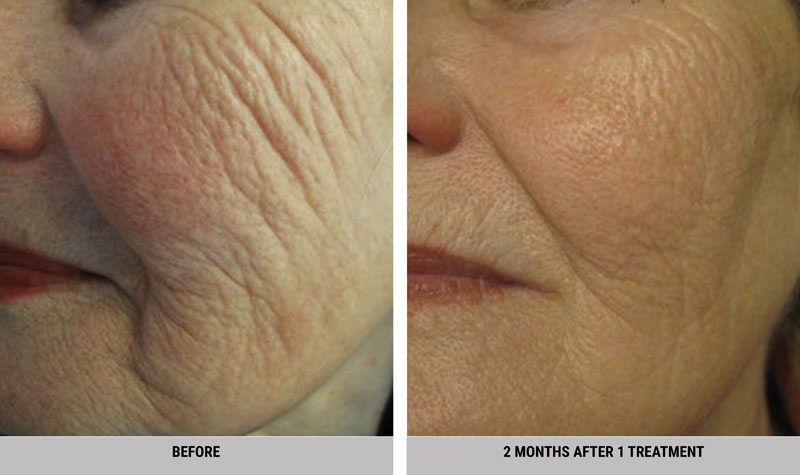 Dream Spa Medical Blog | Skin Tightening Treatment with Natural Results and Better Looking Skin