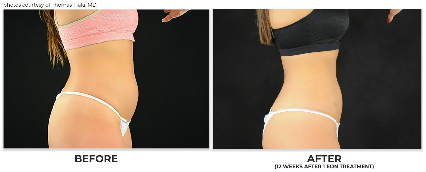 EON: The Premier Touchless Body Contouring Treatment - Brookline, MA