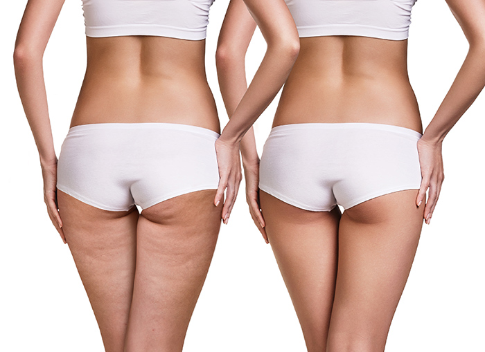 Dream Spa Medical Blog | Cellulite Treatment that has Proven, Visible Results in Adult WomenGet to know all about QWO