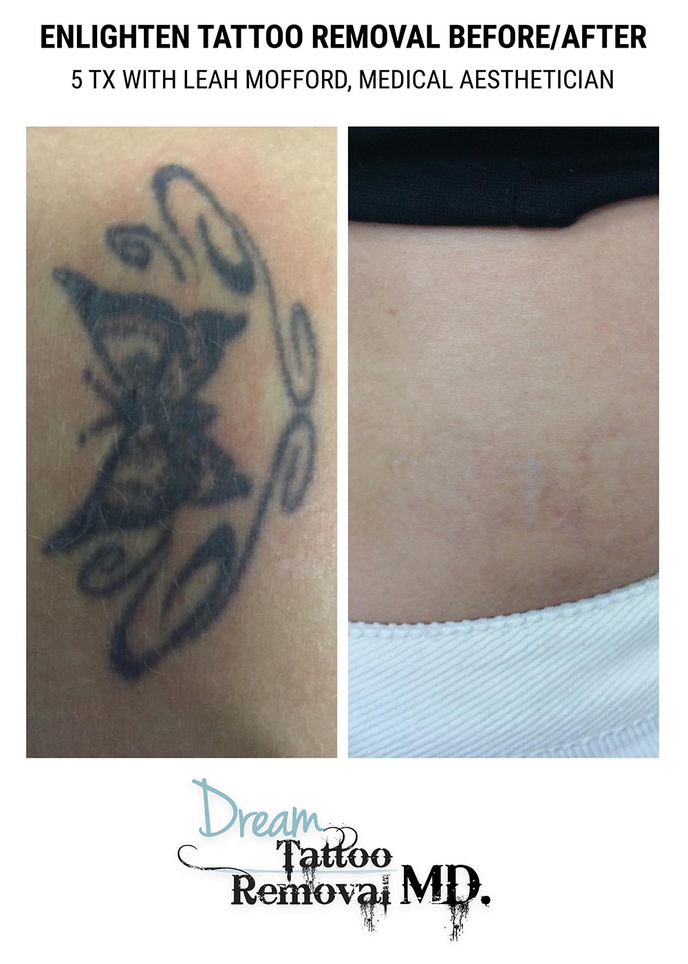 Laser Tattoo Removal  Fayetteville Skin  Body Aesthetics