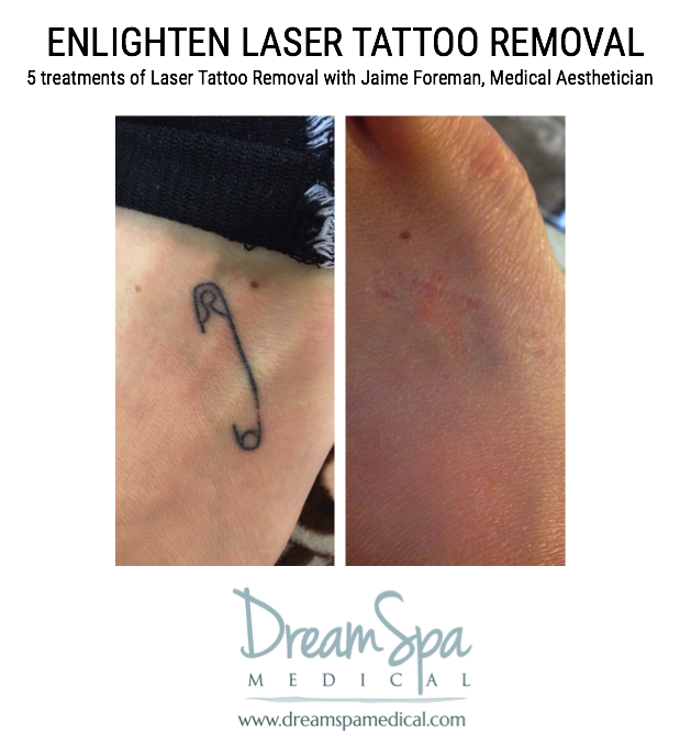 Six Facts You Might Have Not Known About Laser Tattoo Removal | North  Houston Laser Tattoo Removal