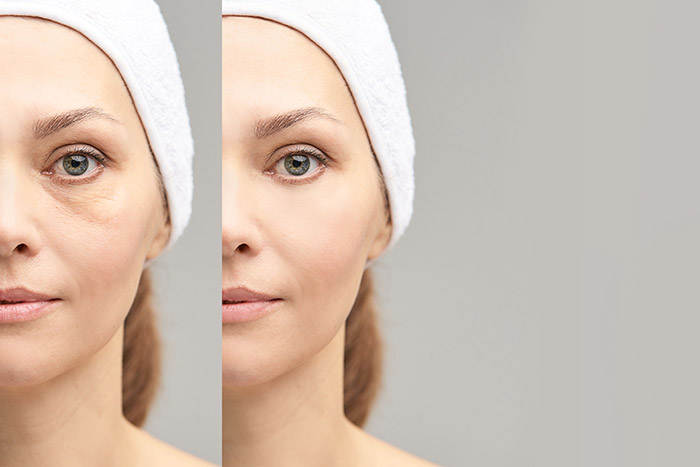 Dream Spa Medical Blog | Get Rid of Annoying Undereye Hollows and Dark Circles and Rejuvenate Your Appearance