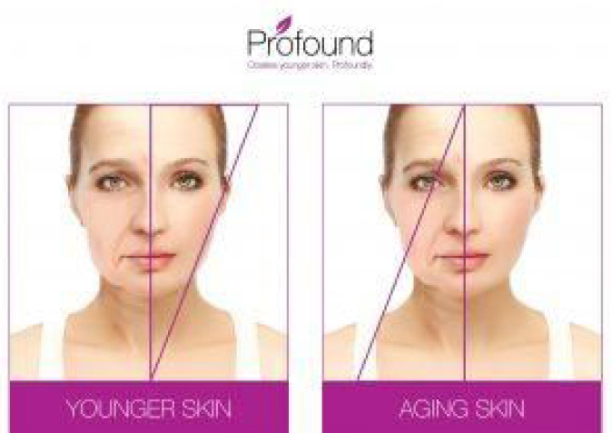 Dream Spa Medical Blog | Profound Skin Tightening Treatment Lets You Put Your Best Face Forward