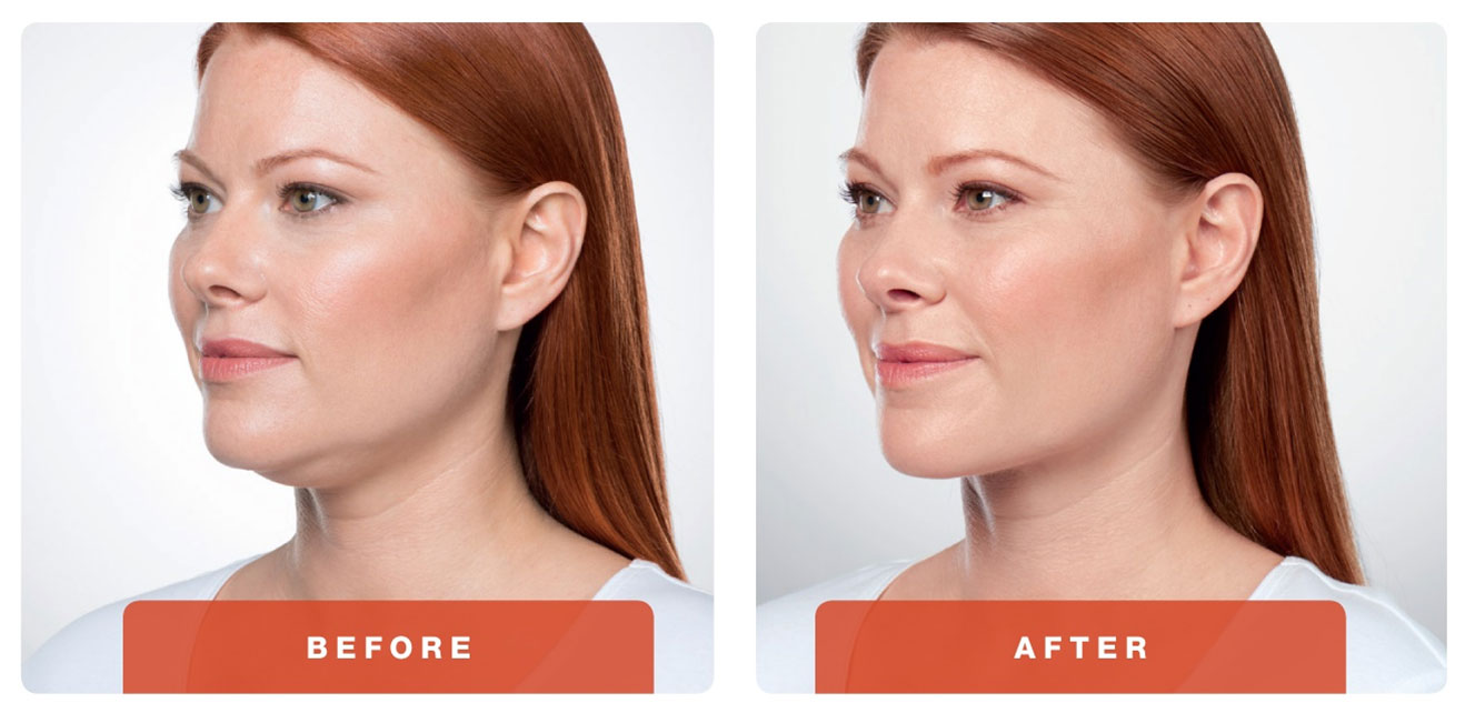 Dream Spa Medical Blog | Say Goodbye to Your Double-Chin with KYBELLA®