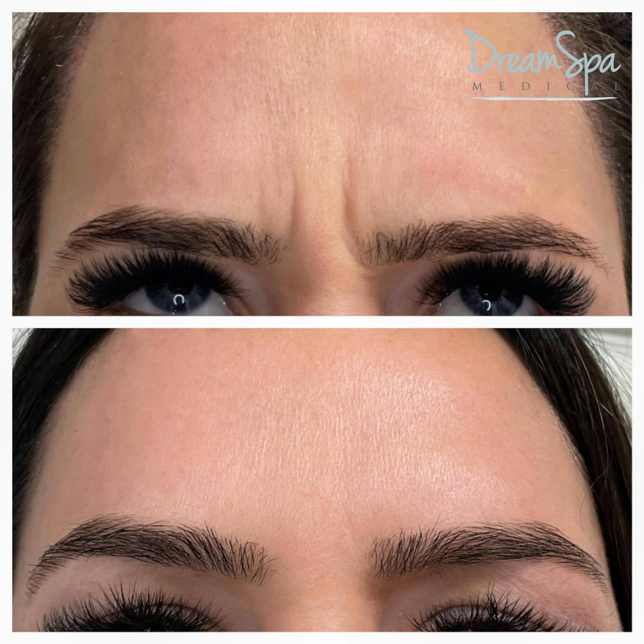 Botox Before & After Gallery - Patient 72510312 - Image 1