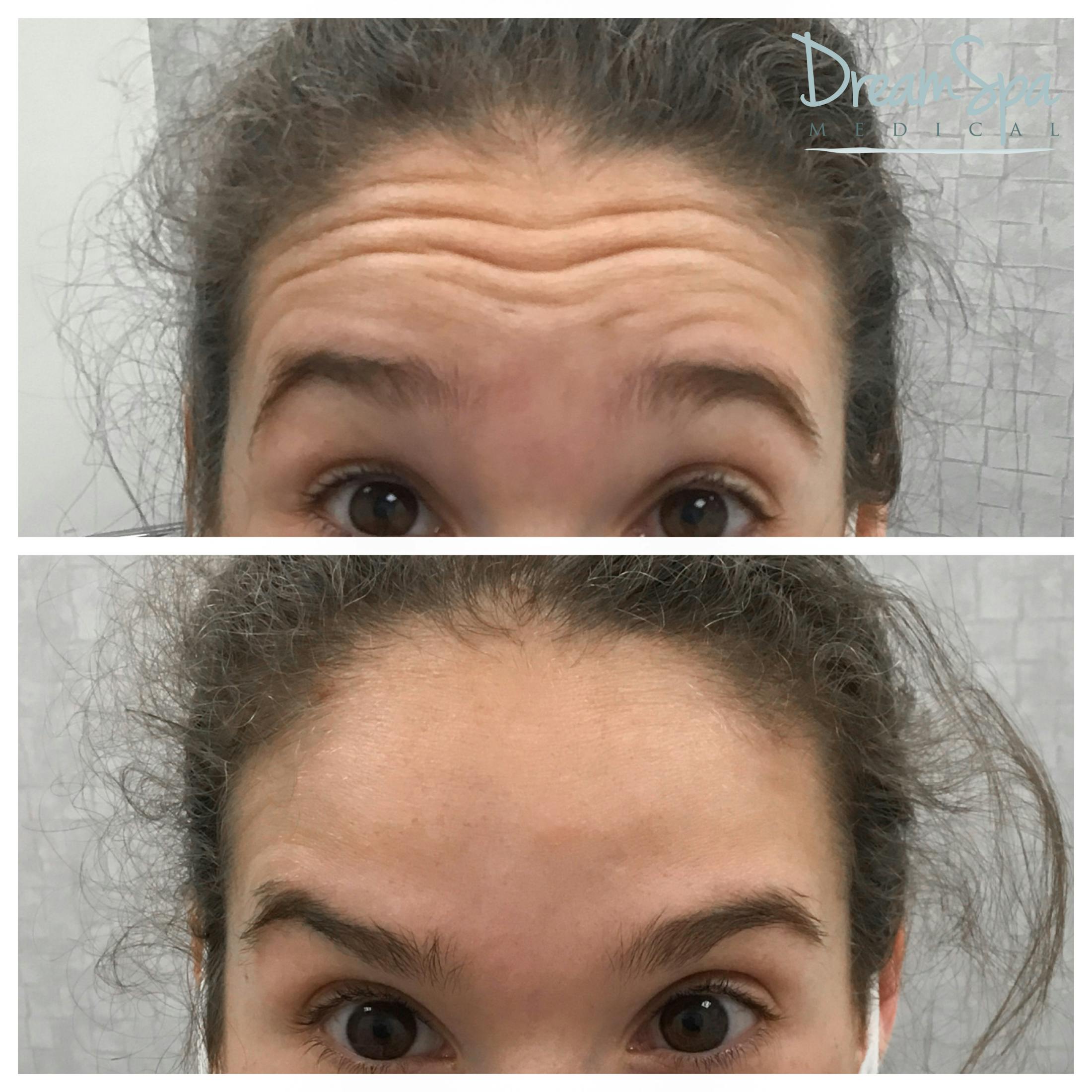 Botox Before & After Gallery - Patient 72510313 - Image 1