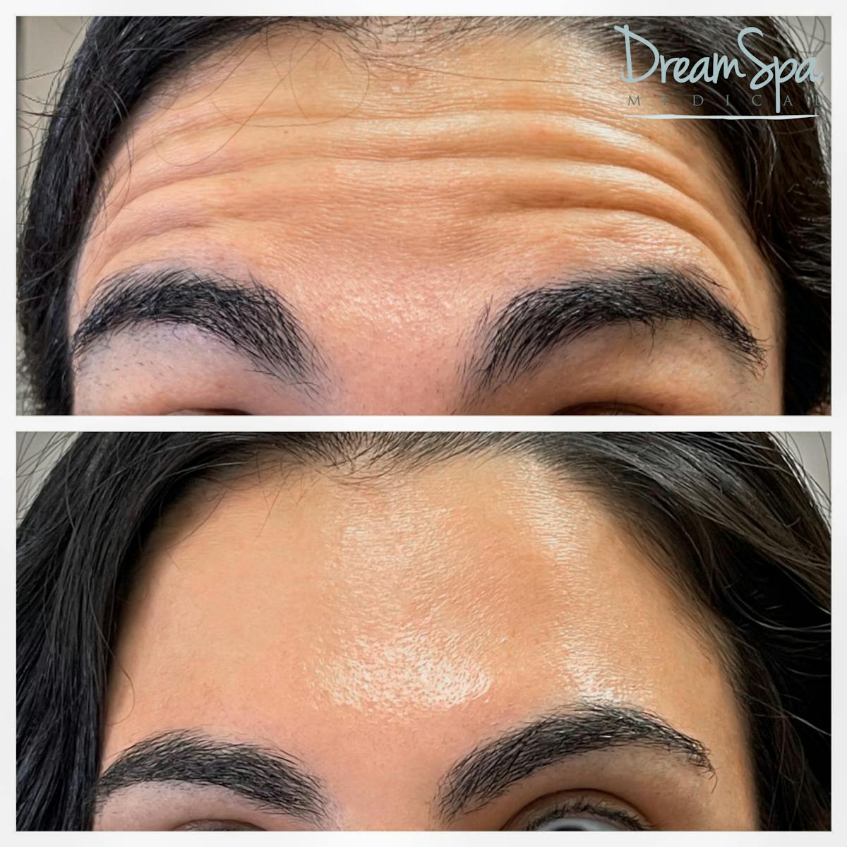 Botox Before & After Gallery - Patient 72510314 - Image 1