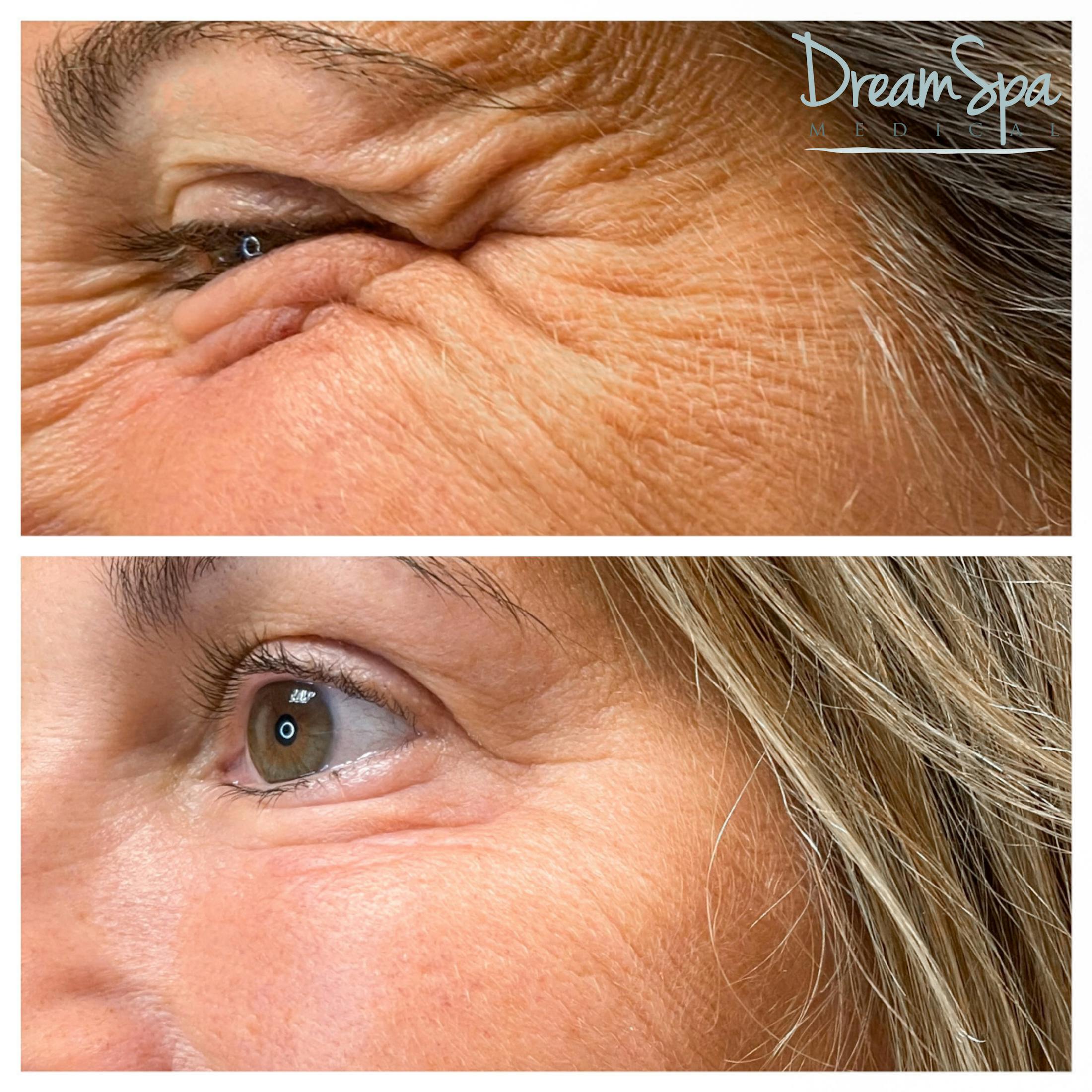Botox Before & After Gallery - Patient 72510315 - Image 1