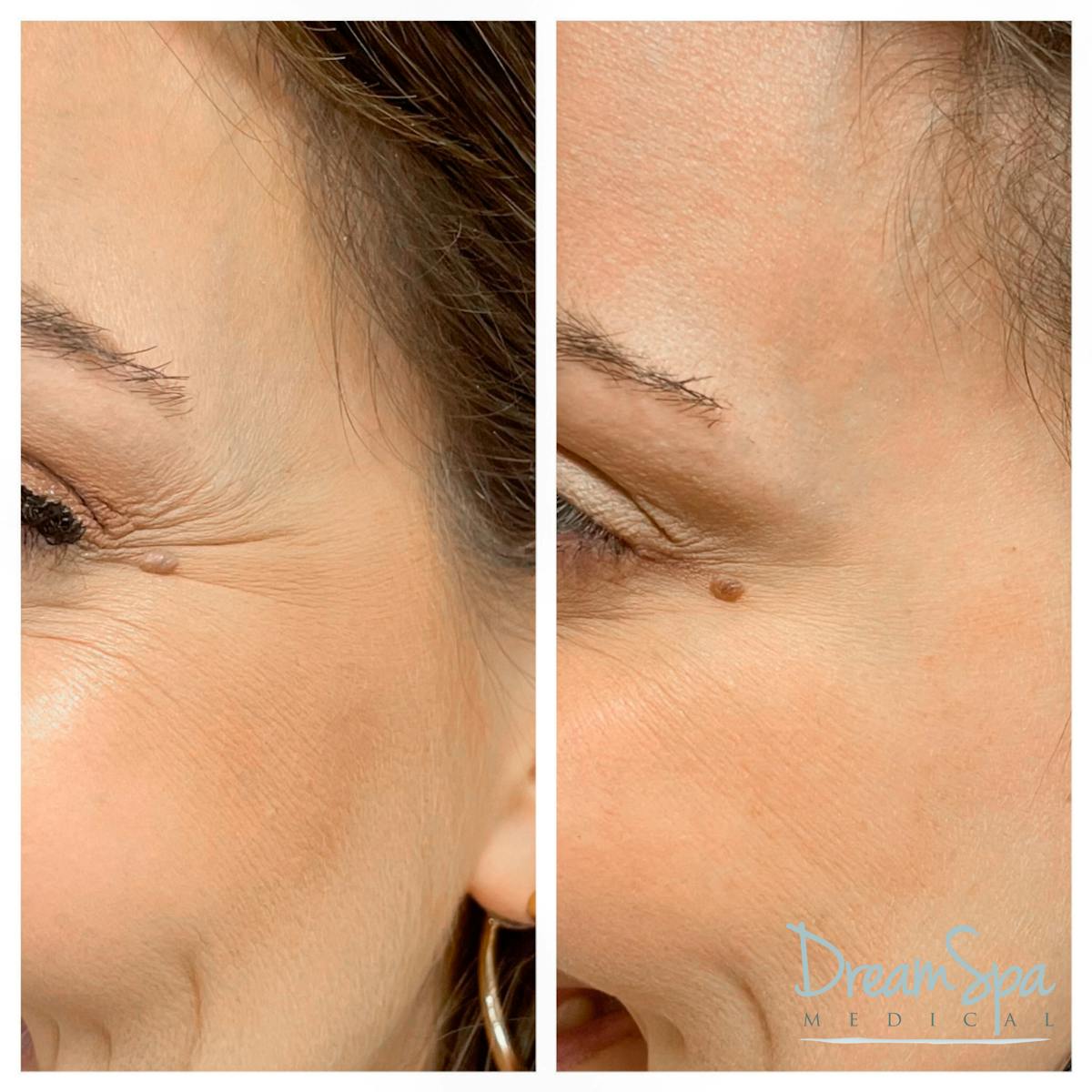 Botox Before & After Gallery - Patient 72510316 - Image 1