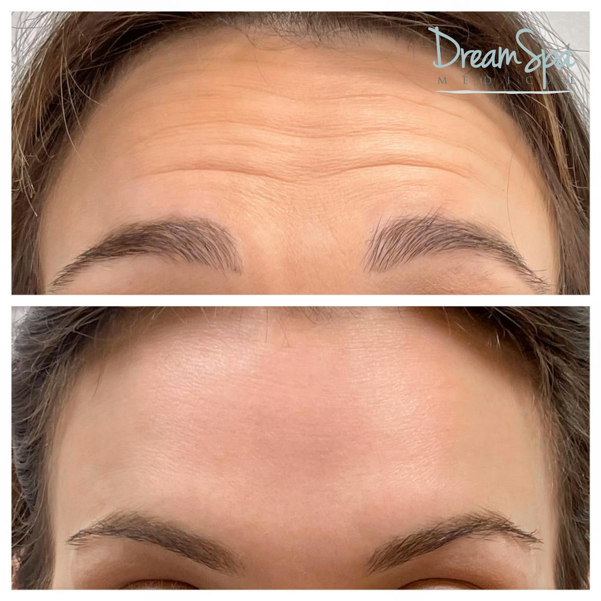 Botox Before & After Gallery - Patient 72510317 - Image 1