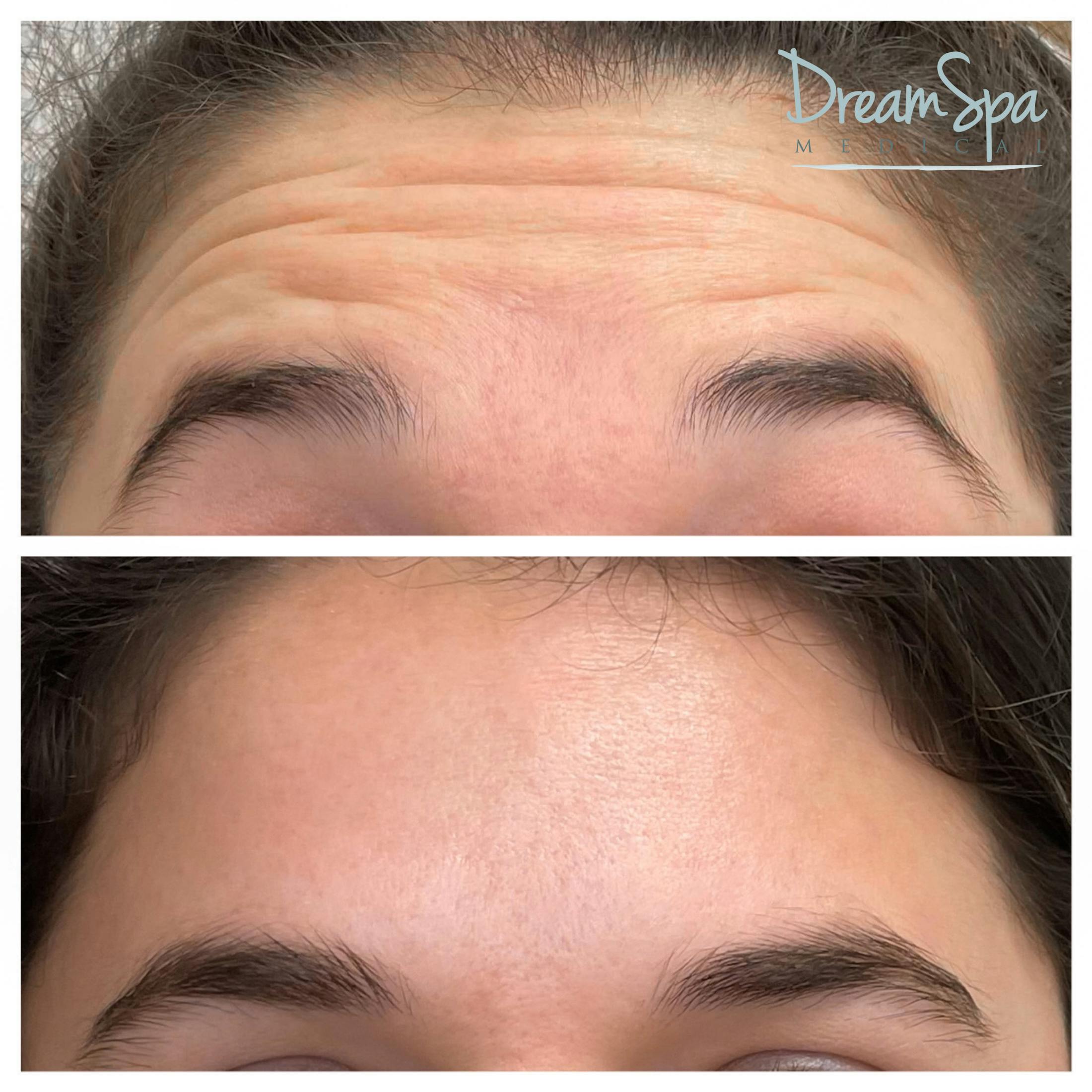 Botox Before & After Gallery - Patient 72510318 - Image 1