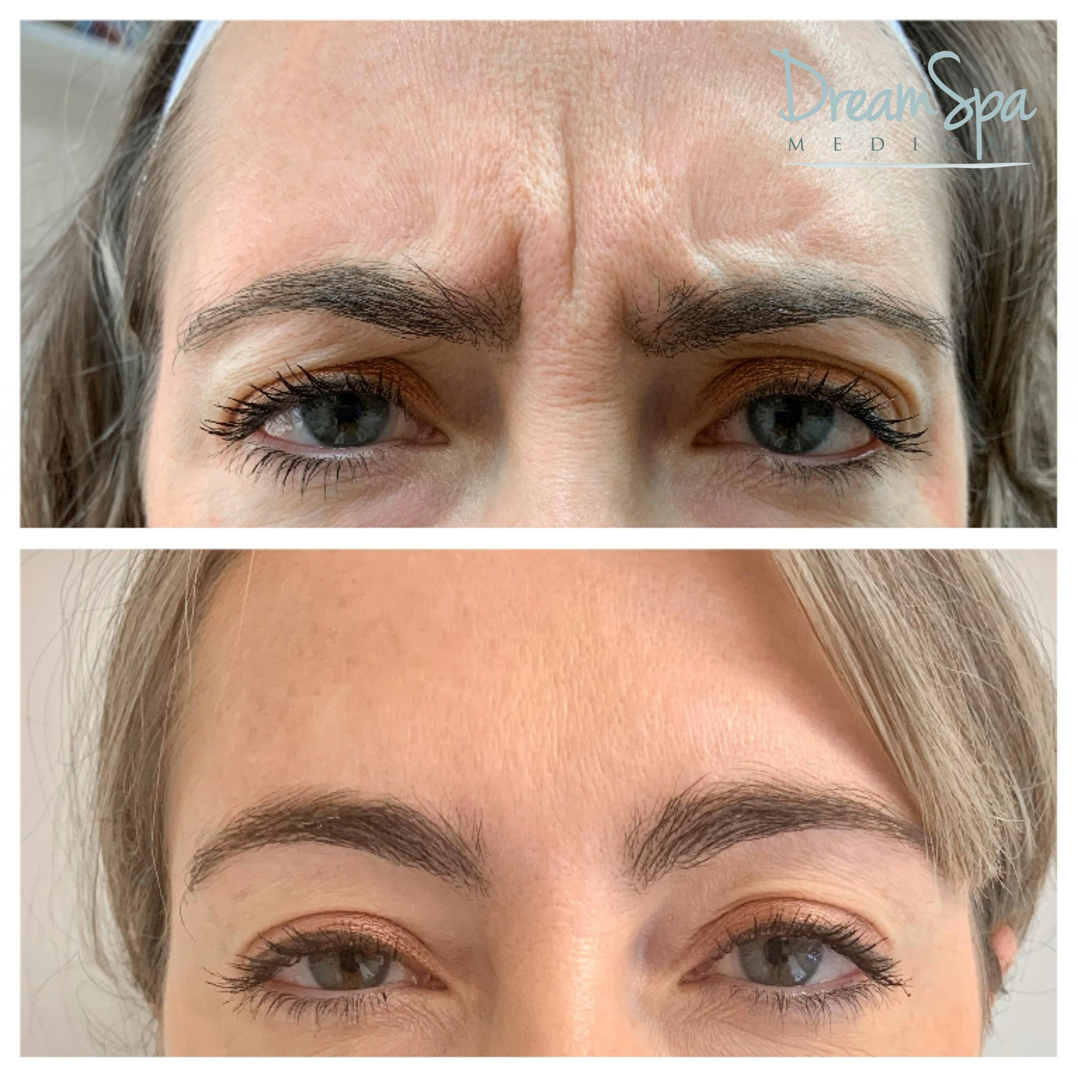 Botox Before & After Gallery - Patient 72510319 - Image 1