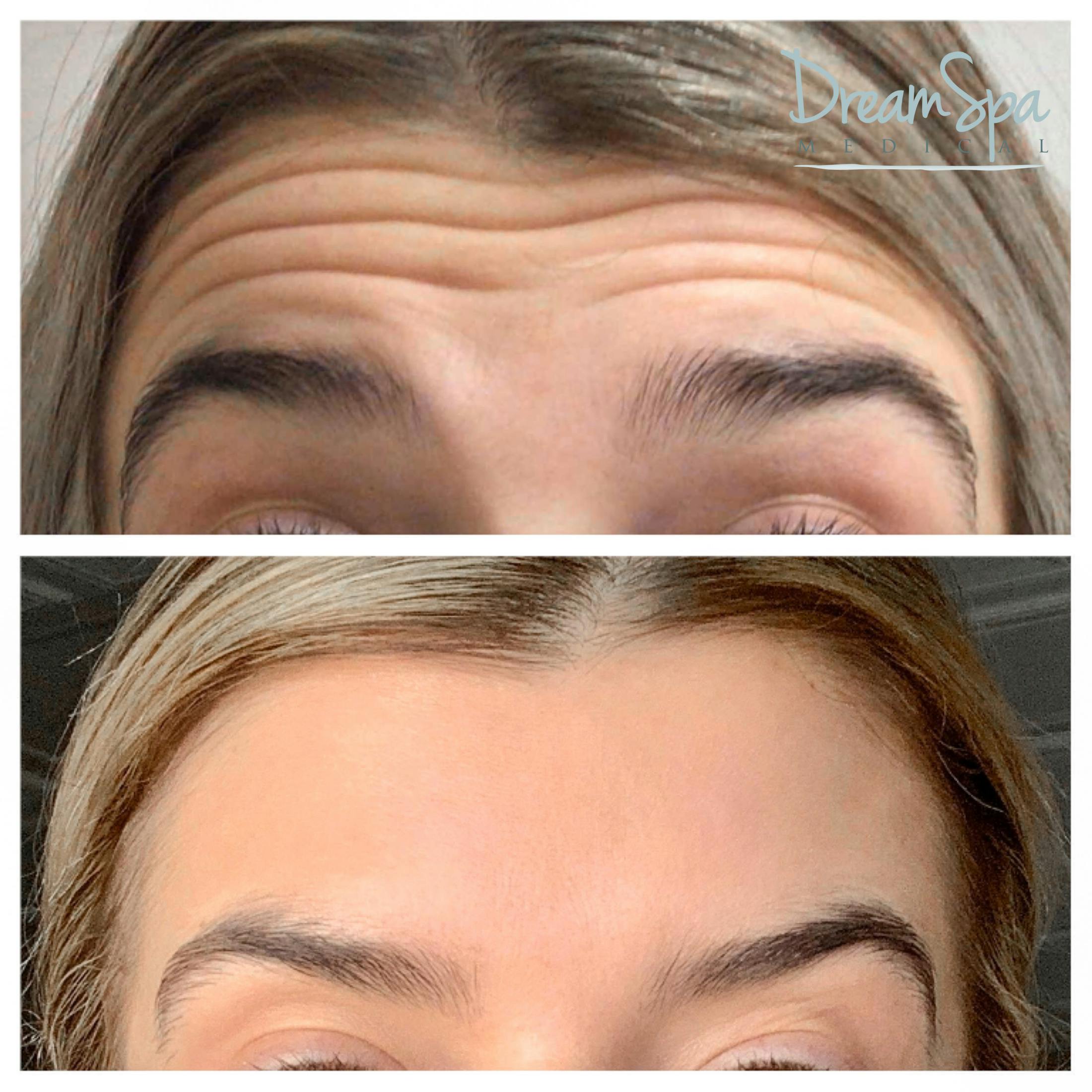 Botox Before & After Gallery - Patient 72510320 - Image 1