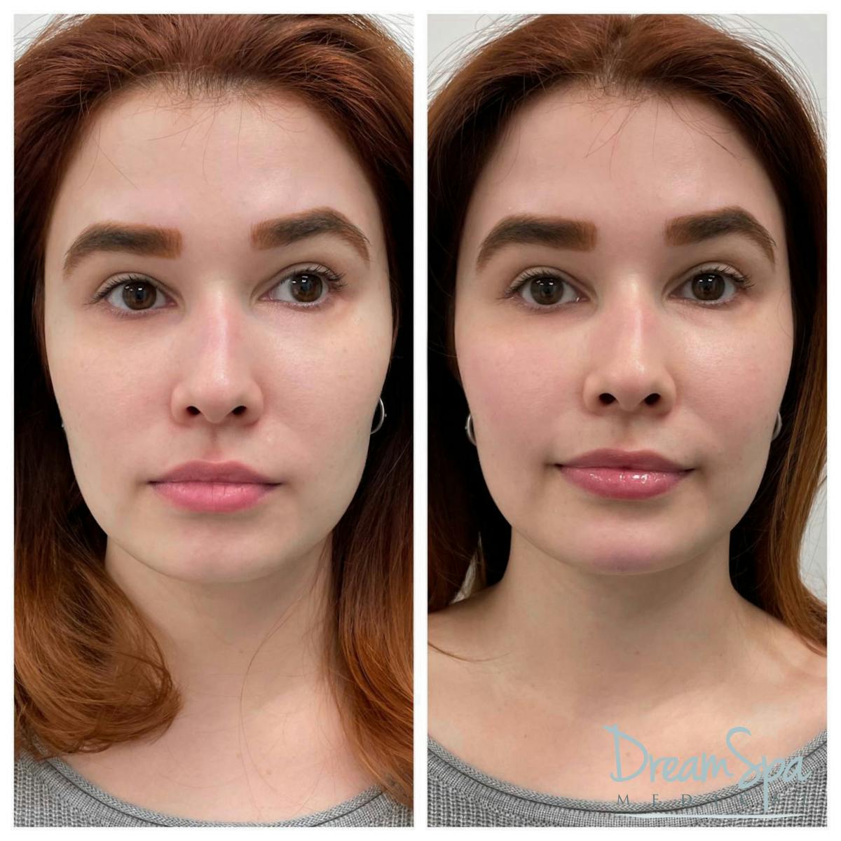 Cheek Filler Before & After Gallery - Patient 72510323 - Image 1