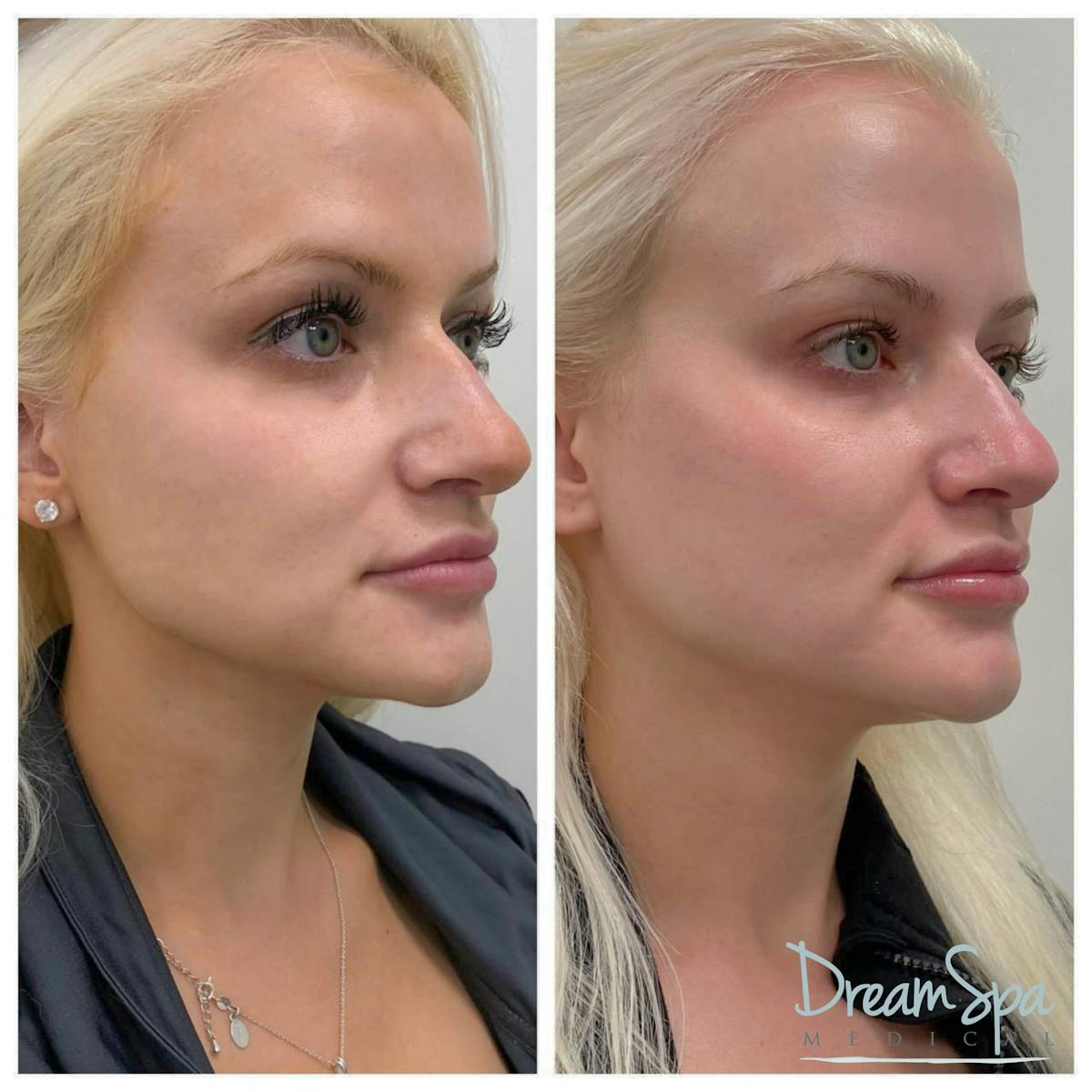 Confident Cheeks Before & After Gallery - Patient 121819239 - Image 1